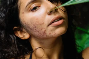 Nodulocystic Acne Causes, Treatment & Recommended Care in South Africa