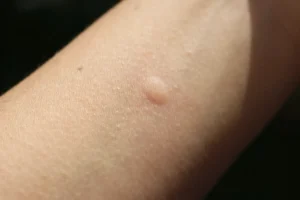 advice for treating insect bites article